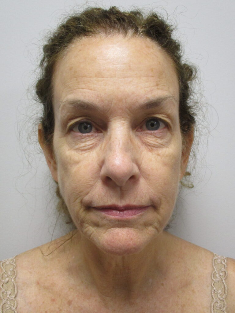 Before Image: Patient F22986 - front