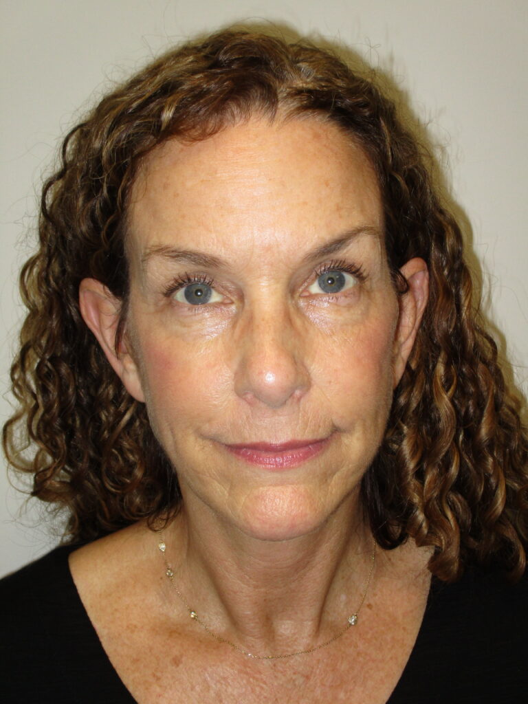 After Image: Patient F22986 - front
