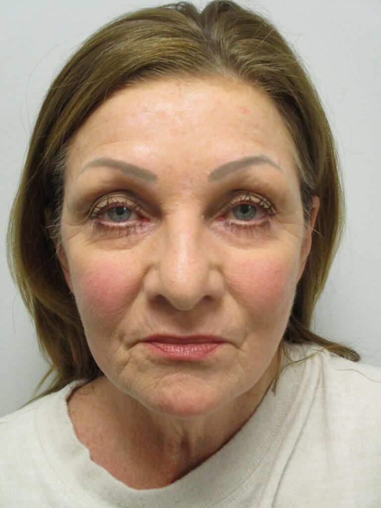 Before Image: Patient F8877 - front