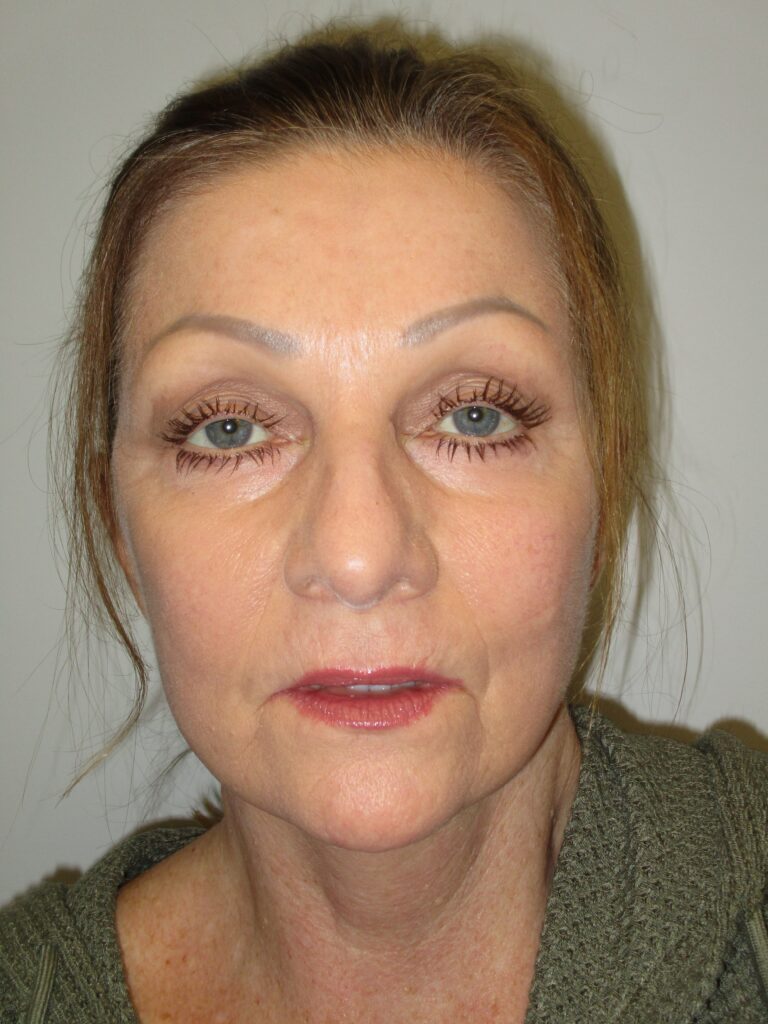 After Image: Patient F8877 - front