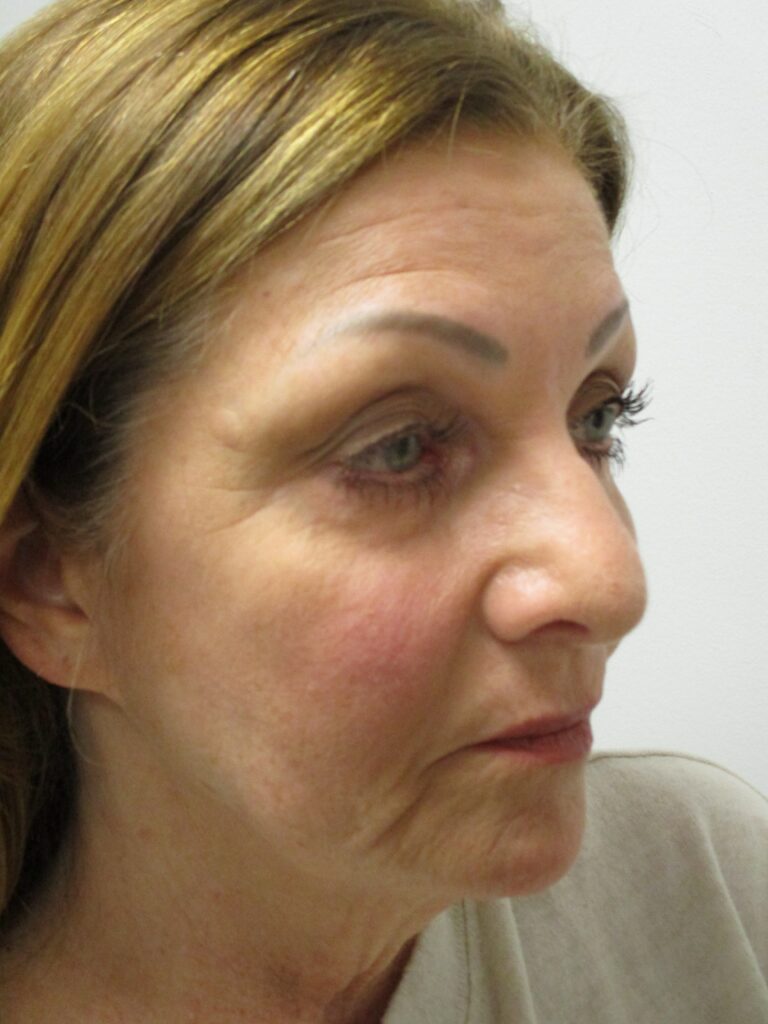 Before Image: Patient F8877 - right-front-oblique