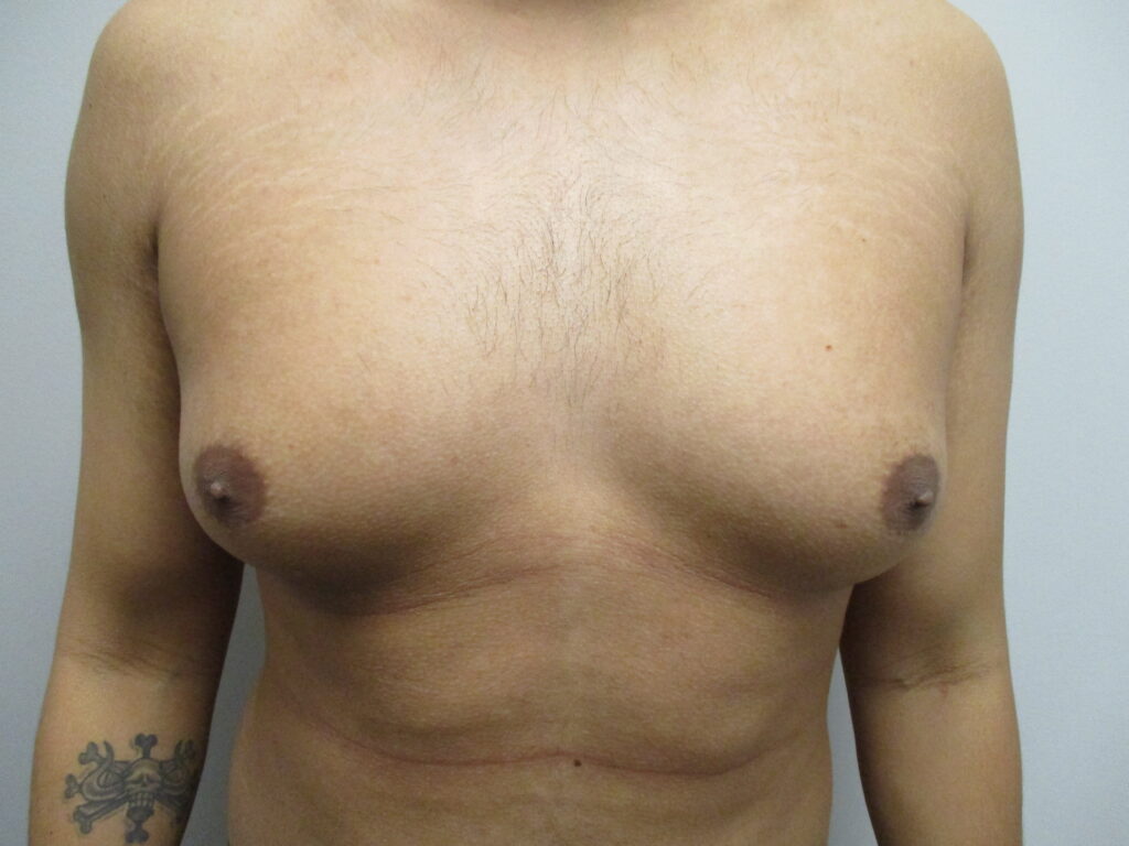 Before Image: Patient 22904 - front