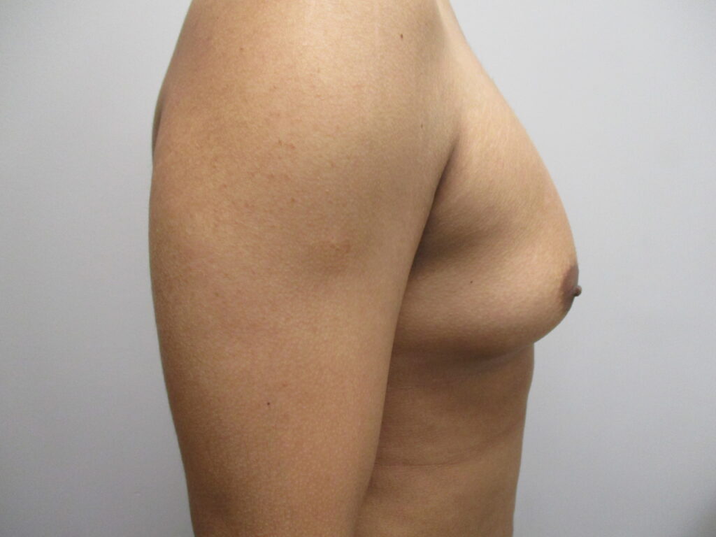 Before Image: Patient 22904 - right-side