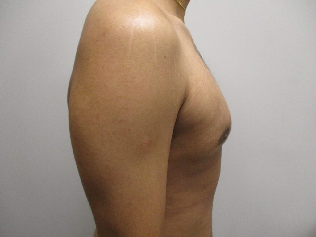 After Image: Patient 22904 - right-side